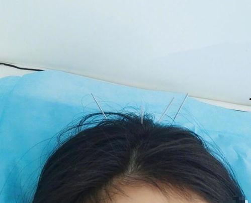 明星网红扎针灸疼痛大哭