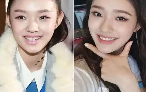 明星网红牙贴面图片大全,美丽笑容背后的秘密